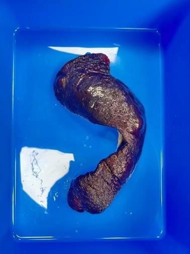 Photograph of a removed spleen on a surgical tray